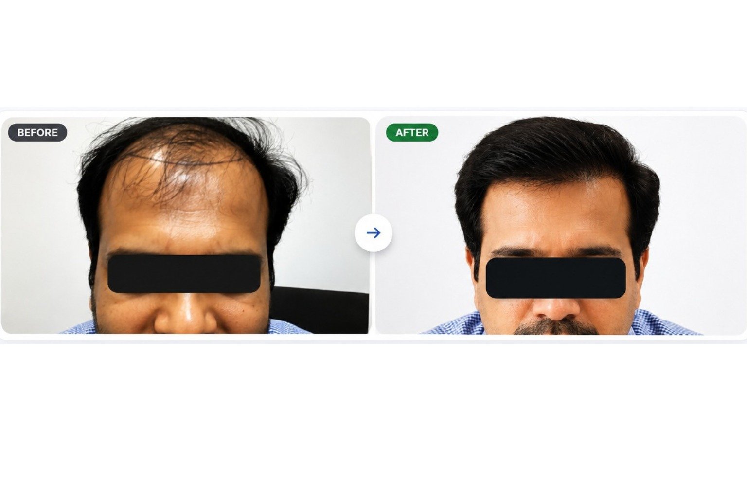 Patient 6 Before and After Hair Transplant
